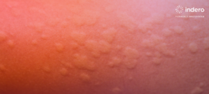 Challenges of Managing Clinical Trials in Urticaria in 2025